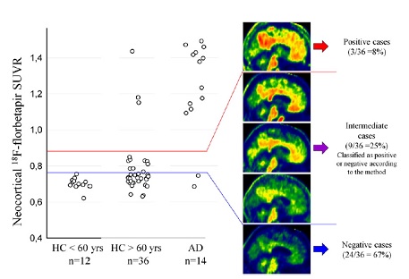 Amyloid Imaging. Source (사진출처- NeuroImage: Clinical)