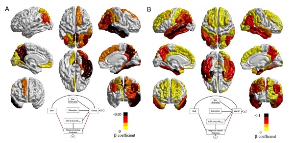 유전인자가 대뇌피질 위축을 일으킴을 보여주는 그림