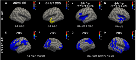 근감소증 진단 (A)과 달리 근육의 강도가 약할수록 좌측 측두엽의 위축 (B), 근육의 기능이 저하되었을수록 양측 섬염의 위축이 심했으며 (C), 근육의 양은 많을수록 양측 전두엽과 두정엽의 아밀로이드 축적이 적게 나타났다. / 여의도성모병원