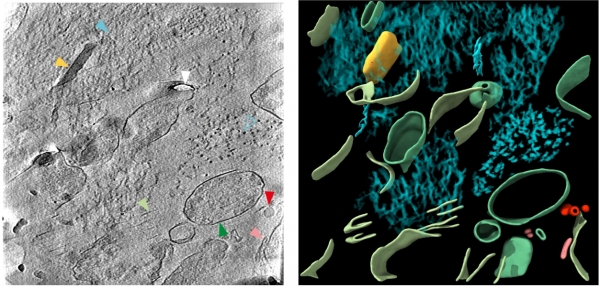(왼쪽) 사후 알츠하이머병 환자 뇌 냉동 절편에서 아밀로이드 베타 단층 촬영 (오른쪽) 왼쪽 단층 촬영에서 색을 입혀 표시된 세부 영역