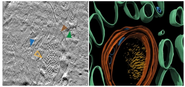 (왼쪽) 사후 알츠하이머병 환자 뇌 냉동 절편에서 아밀로이드 베타 단층 촬영 (오른쪽) 왼쪽 단층 촬영에서 색을 입혀 표시된 세부 영역