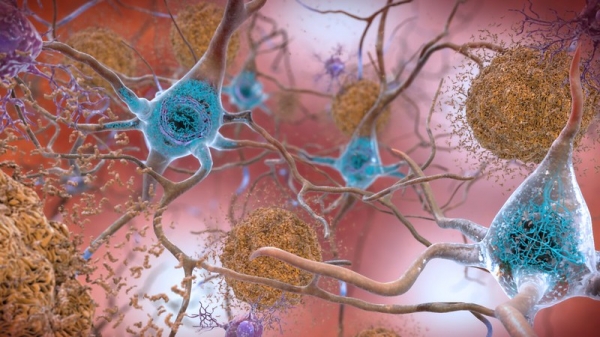 Beta-Amyloid Plaques and Tau in the Brain / NIH flickr