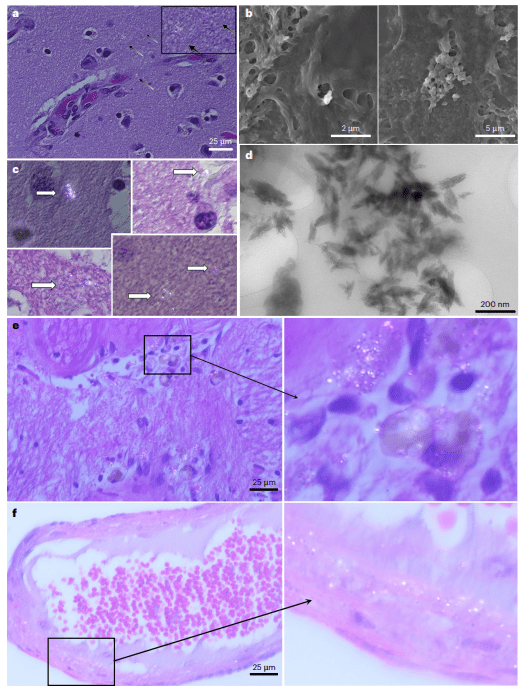 뇌에 있는 플라스틱 추정 물질의 시각화 / nature.com/articles/s41591-024-03453-1