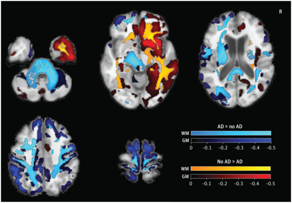 Detection of Alzheimer Neuropathology in Alzheimer and Non-Alzheimer Clinical Syndromes With Blood-Based Biomarkers(2025)