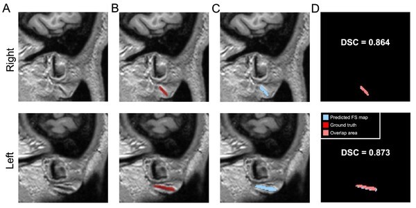 출처=Advancements in Frank’s sign Identification using deep learning on 3D brain MRI, Sci Rep 15, 2383 (2025)